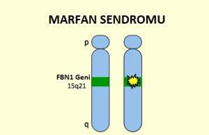 Marfan Sendromu Nedir Bilgiustam