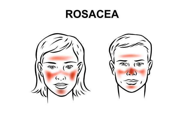 Розацеа схема лечения на лице